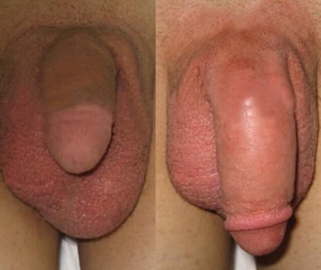 The result of installing a collagen matrix in the penis
